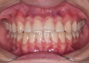 第2大臼歯のみが咬合している重度の開咬症例
