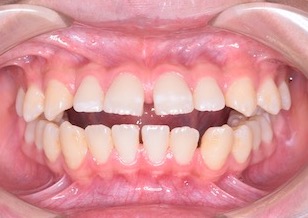 第2大臼歯のみが咬合している重度の開咬症例